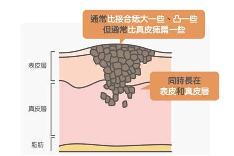 接合痣